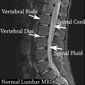 Normal MRI tagged