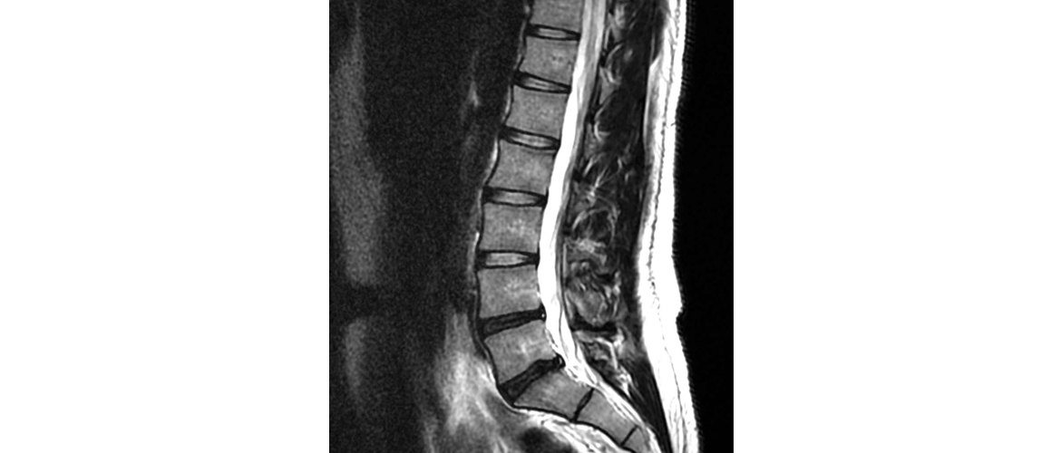 MRISlider-Herrington-Family-Chiropractic-Buffalo-back-pain-radiculopathy-hip-lumbar-sacroiliac-disc-herniation-fascia-sciatica-knee-14221-14120-Amherst-Tonawanda-Williamsville-Back-Pain